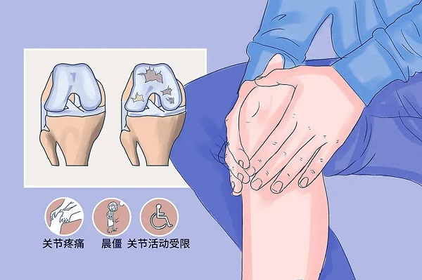 膝關(guān)節(jié)骨性關(guān)節(jié)炎