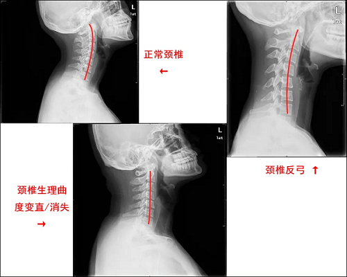 頸椎生理曲度