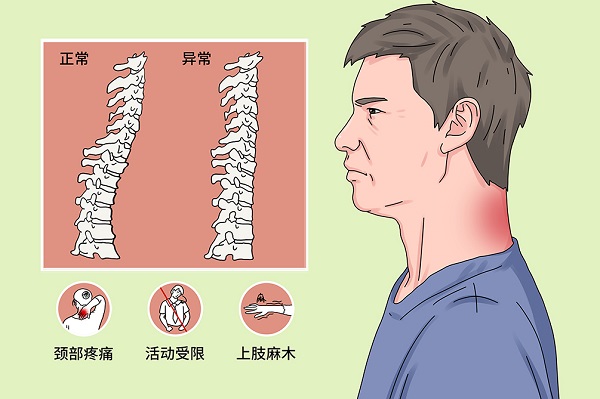 頸椎曲度變直危害
