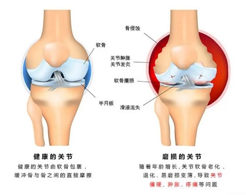 關(guān)節(jié)對(duì)比圖