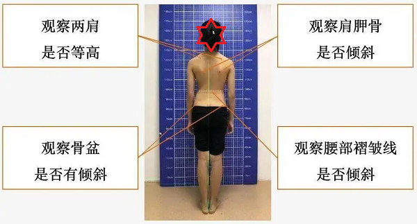 脊柱側(cè)彎觀察體態(tài)變化方法