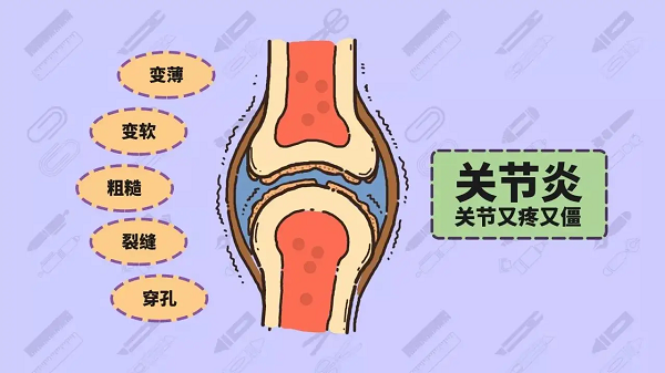 關(guān)節(jié)炎癥狀