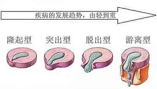 椎間盤突出疾病發(fā)展趨勢(shì)