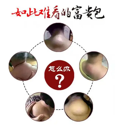 如此難看的富貴包怎么辦？