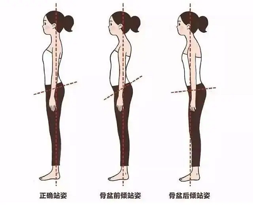 骨盆不同狀態(tài)站姿差異圖