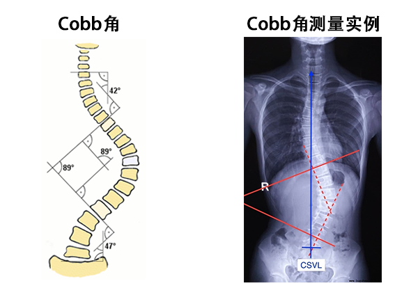 脊柱側(cè)彎cobb角測(cè)量方法